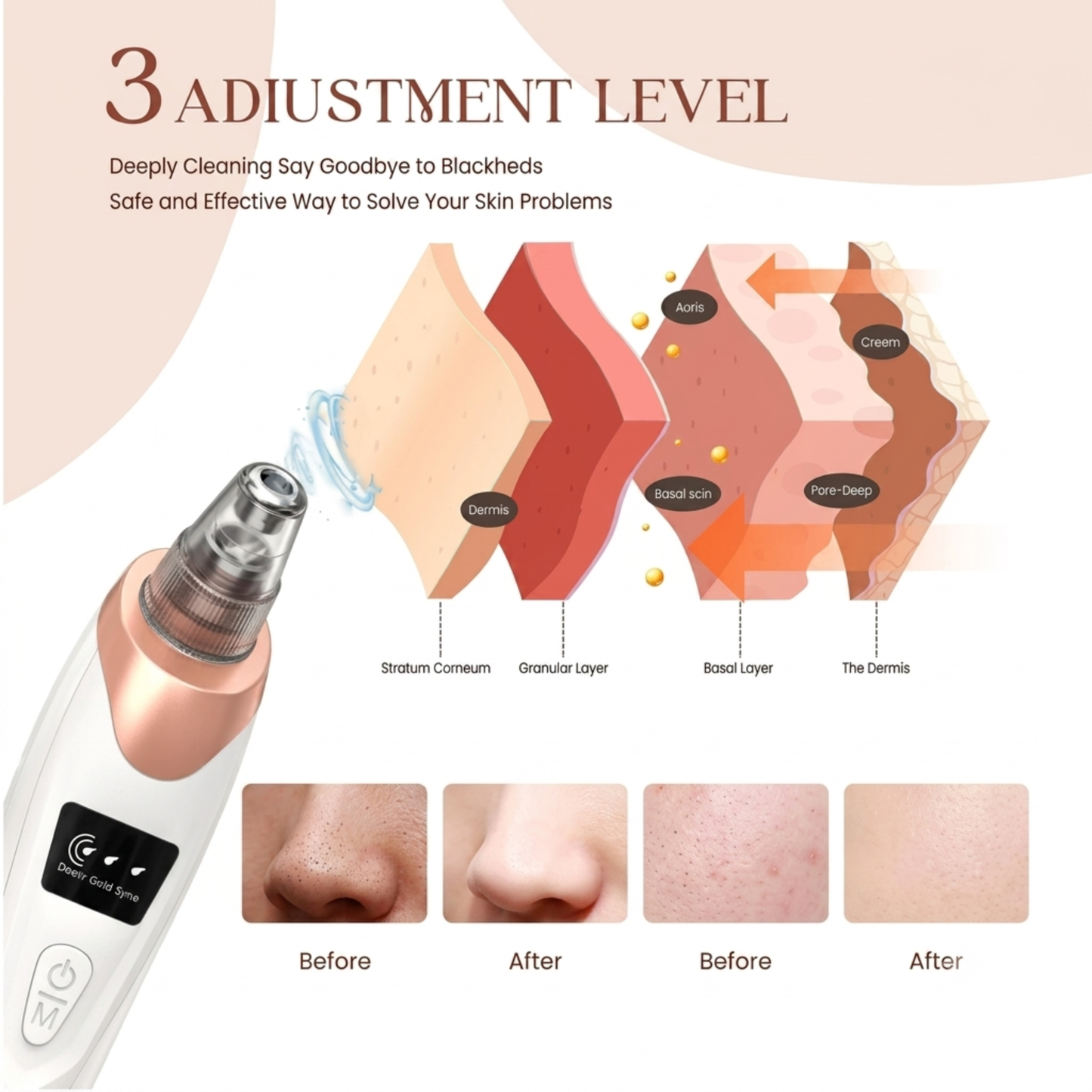 Black Head Remover Machine